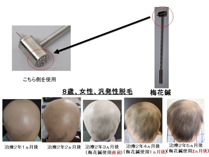 円形脱毛症　病院